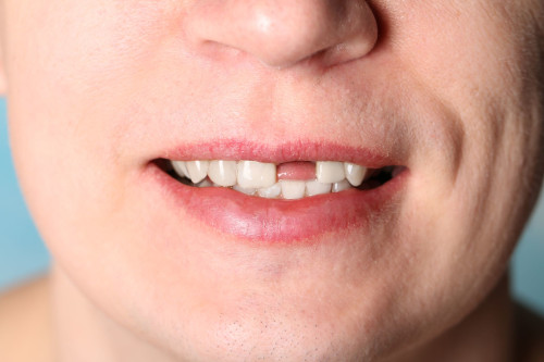 Почему могут выпадать зубы у взрослых